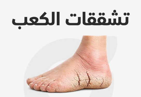 علاج تشقق الأقدام الشديد